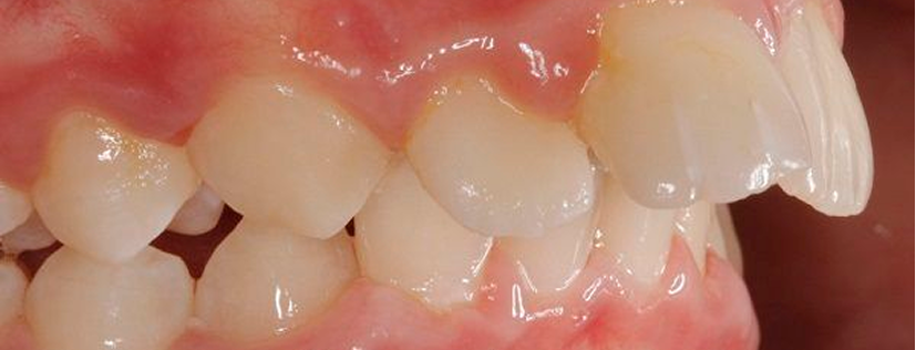 前歯が出ている