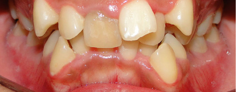 歯並びがガタガタ