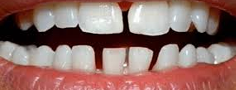 すきっ歯が気になる