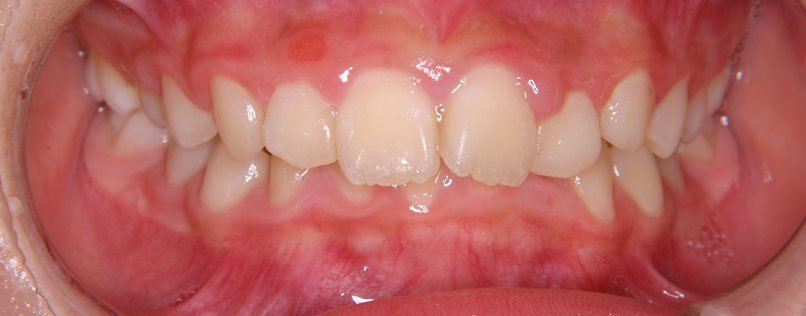 噛み合わせが深い