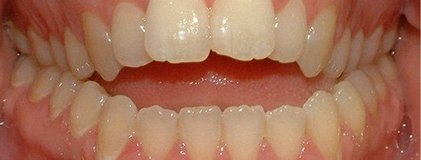 前歯で噛めない