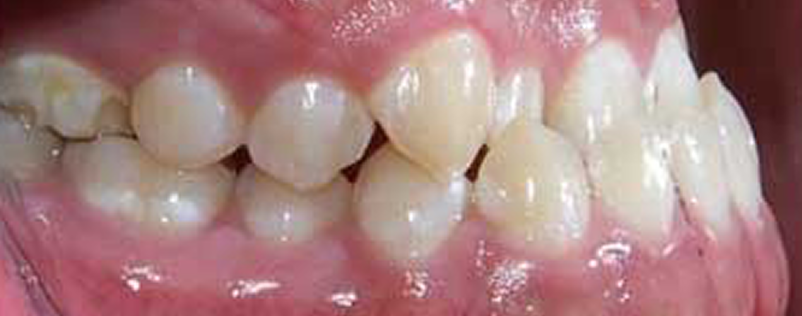 受け口が気になる