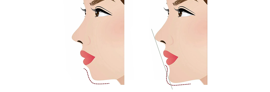 横顔のバランスを整えたい