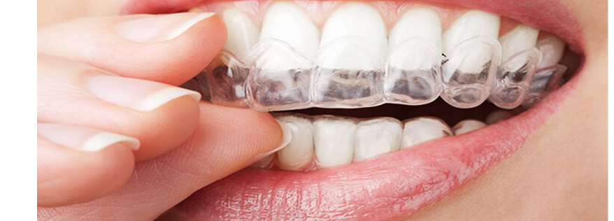 目立たない矯正がしたい