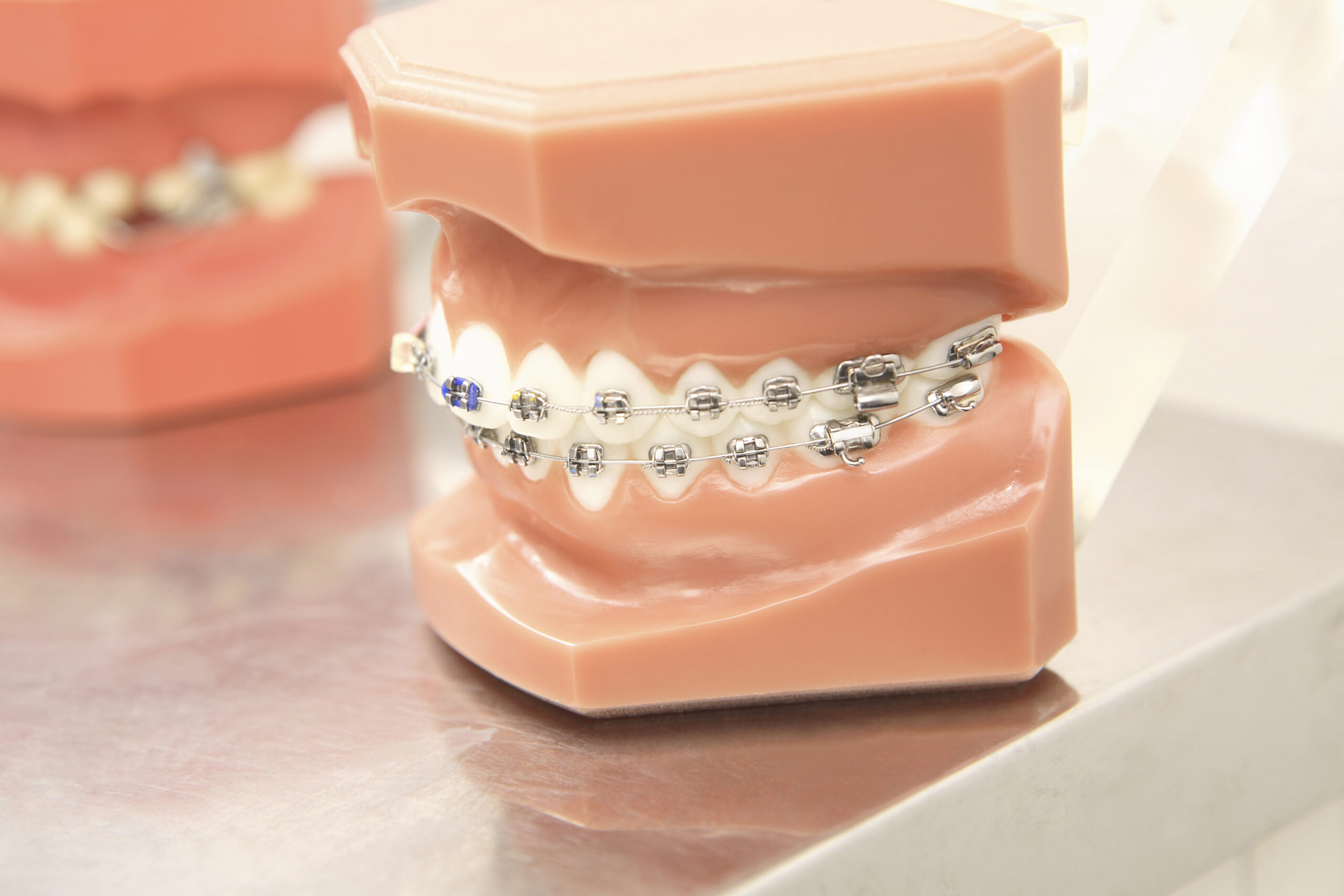 ワイヤー矯正とは