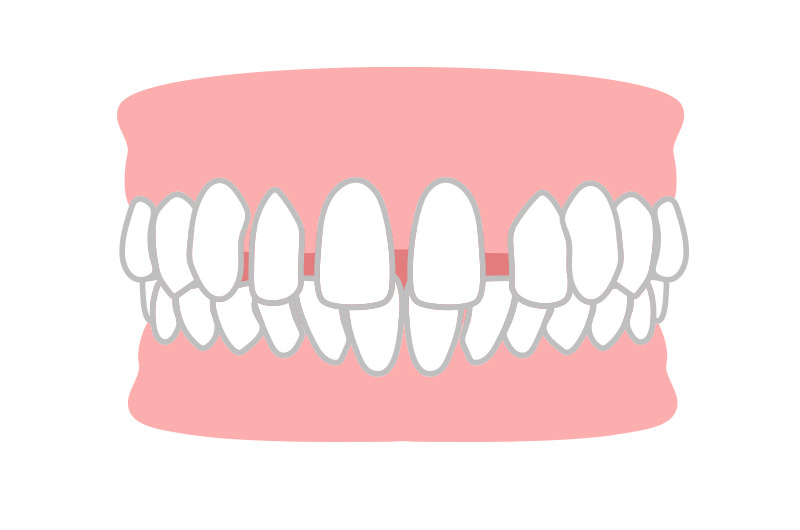 空隙歯列（すきっ歯）とは