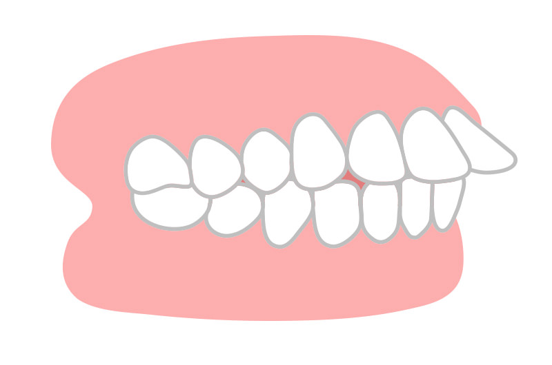 上顎前突（出っ歯）とは