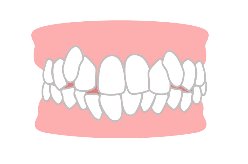 八重歯・叢生（でこぼこ）とは
